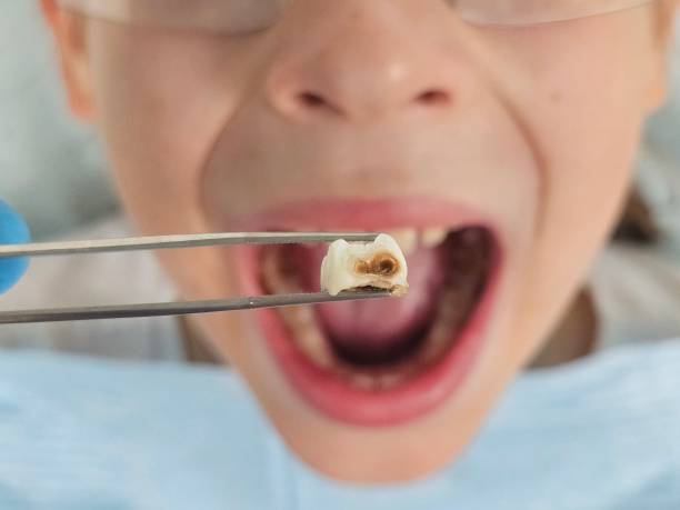 Best Emergency Treatment for Toothache in Santa Claus, IN